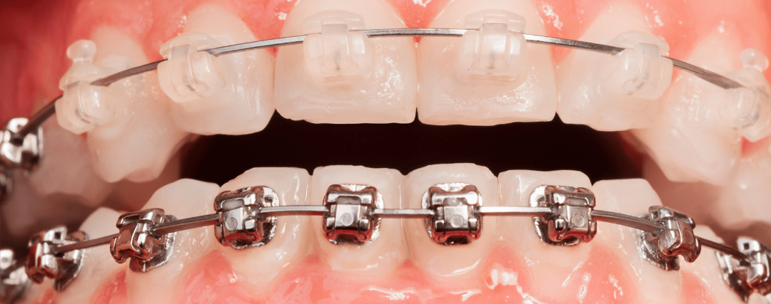 brackets esteticos ortodoncia-tradicional-barcelona