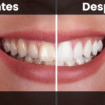 blanqueamiento dental - estetica-dental-barcelona