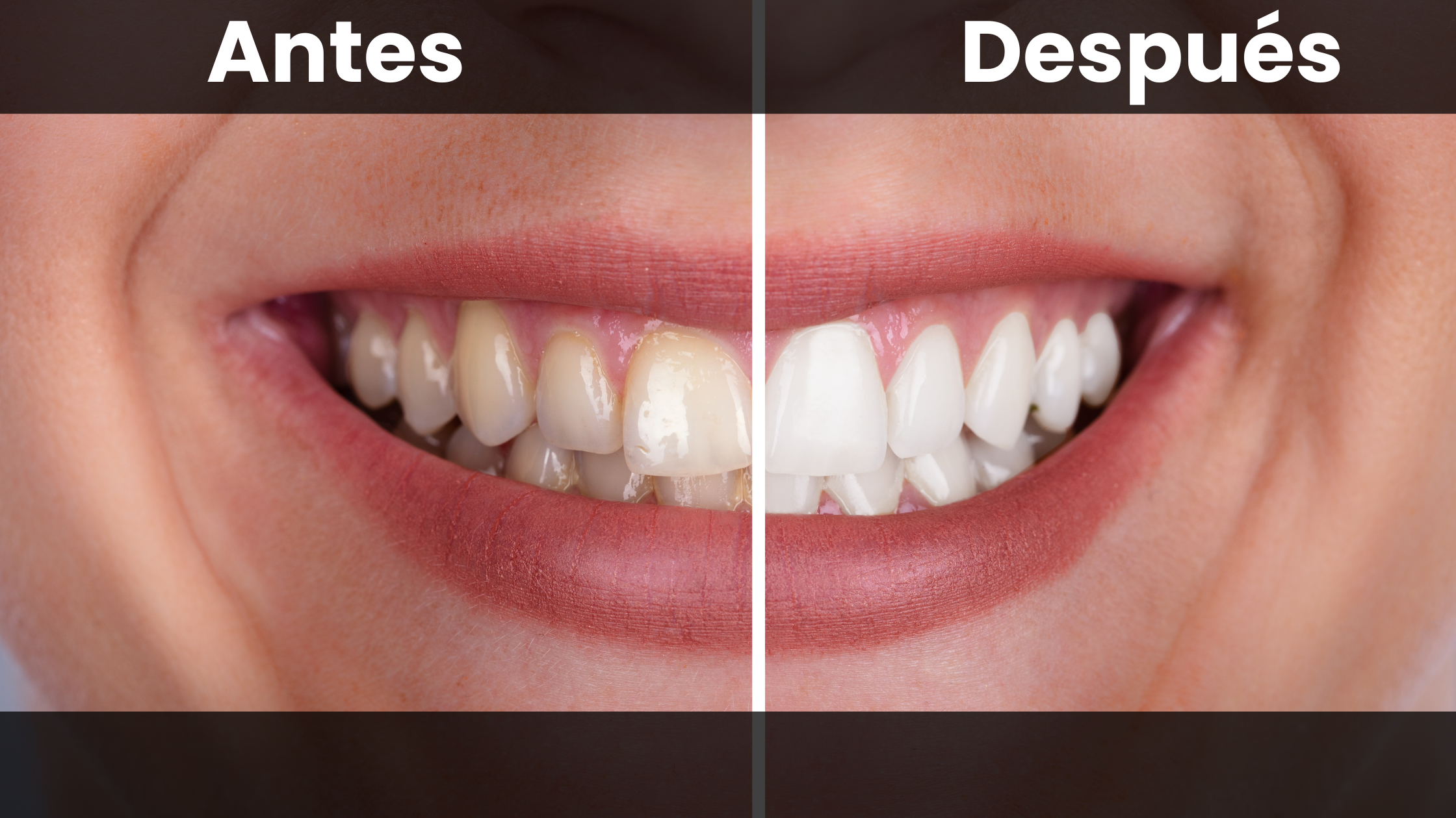 blanqueamiento dental - estetica-dental-barcelona