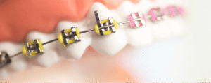 brackets metalicos ortodoncia-tradicional-barcelona