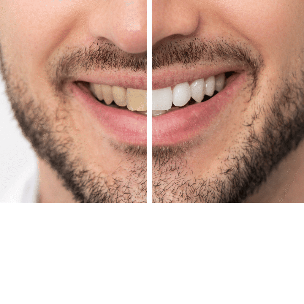 blanqueamiento-2 hombre sonriendo con dientes amarillos y blancos blanqueamiento dental barcelona