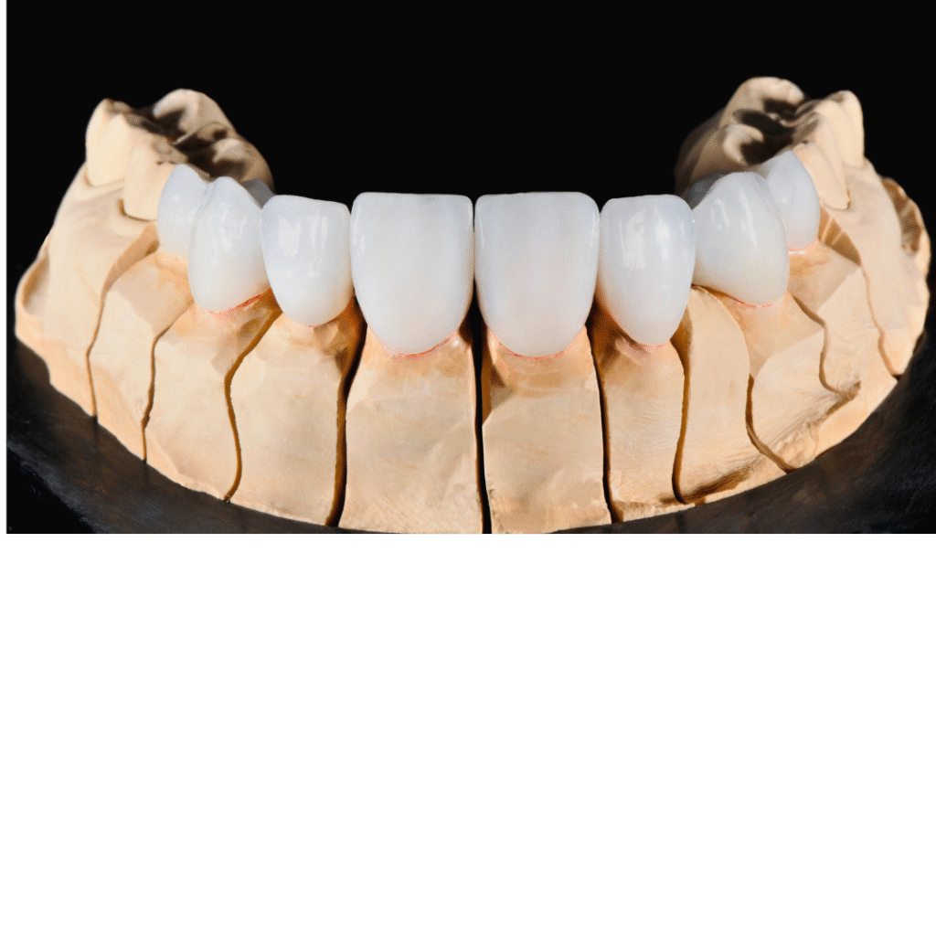 carillas de porcelana - mockup de carillas-dentales-barcelona