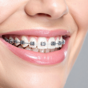 sonrisa brackets sonriendo con brackets metalicos ortodoncia-tradicional-barcelona