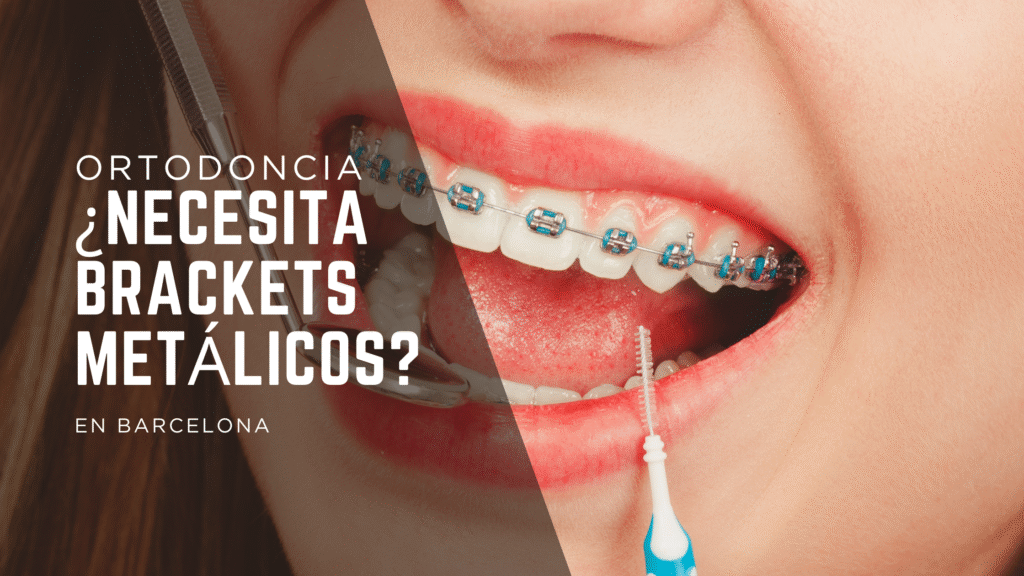 Ortodoncia dental en Barcelona: ¿realmente necesito brackets metálicos?